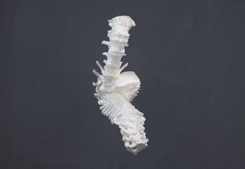 3D printed spine for easier visualization, 3d printing in healthcare